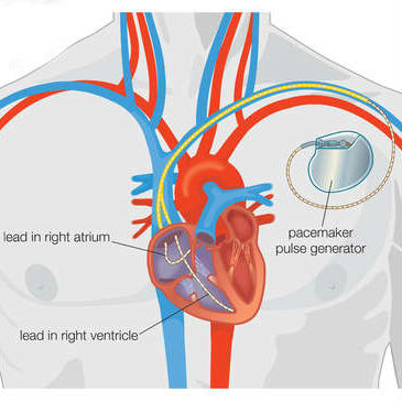 PACEMAKER